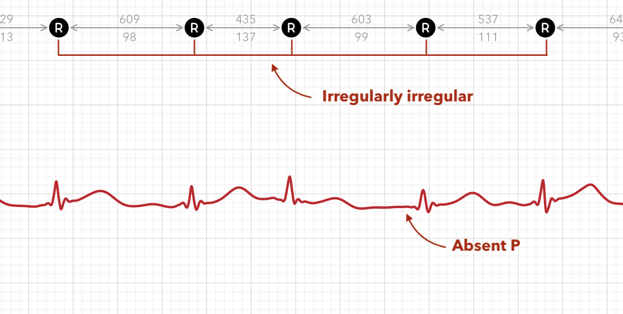 ECG+ AFib irregularity score showing the coefficient of variation (CV%) of beat-to-beat timing