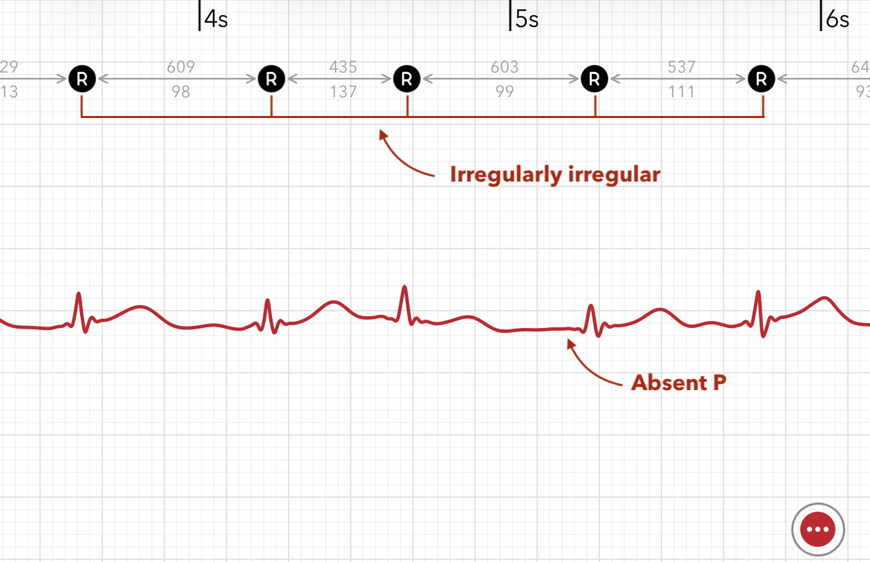 ECG+ App zeigt Vorhofflimmern, das in einer Apple Watch EKG-Aufzeichnung erfasst wurde