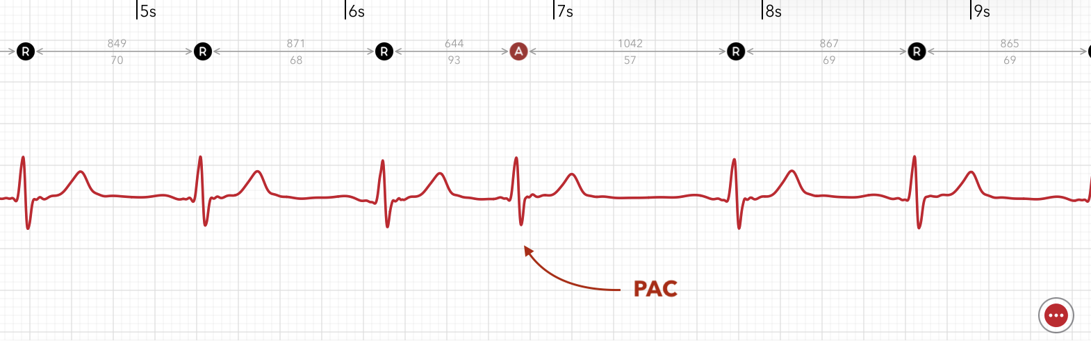 Die ECG+ App erkennt eine supraventrikuläre Extrasystole (SVES) in einer Apple Watch EKG-Aufzeichnung