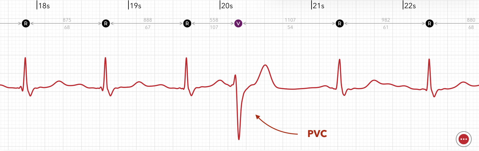 Die ECG+ App erkennt eine ventrikuläre Extrasystole (VES) in einer Apple Watch EKG-Aufzeichnung