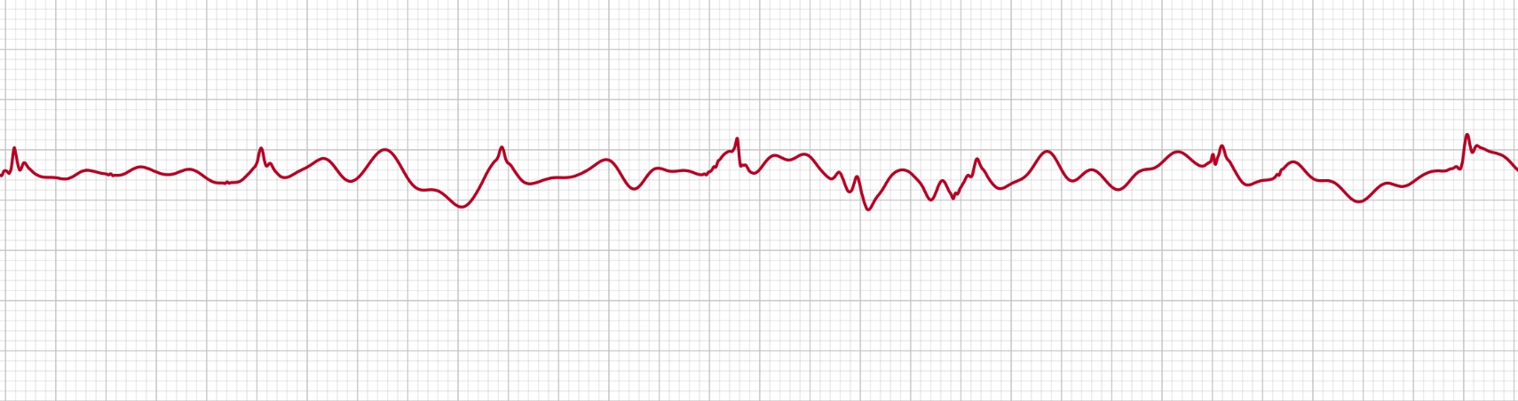An Apple Watch ECG recording spoiled by a damp wrist, moisture at the contacts producing a noisy, unreadable trace