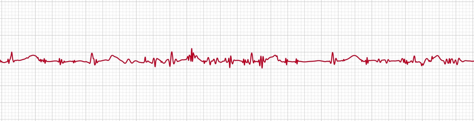 An Apple Watch ECG trace with EMG artifact, a fine spiky fuzz from muscle activity riding on top of the heartbeat and burying the waveform