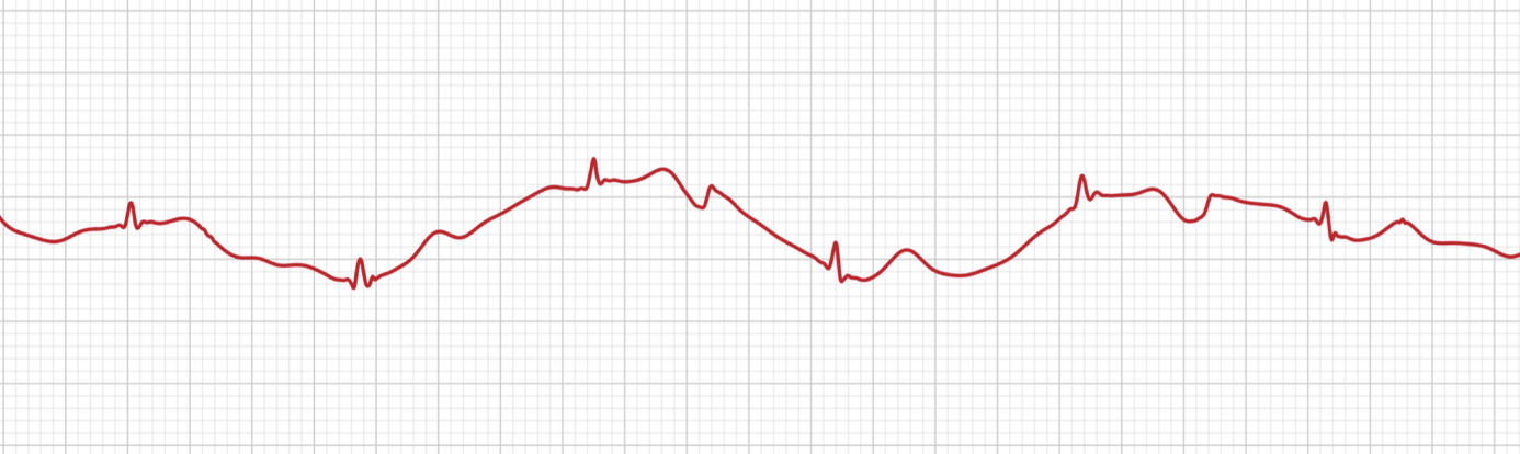 Baseline wander on an Apple Watch ECG, the trace drifts up and down away from the flat baseline