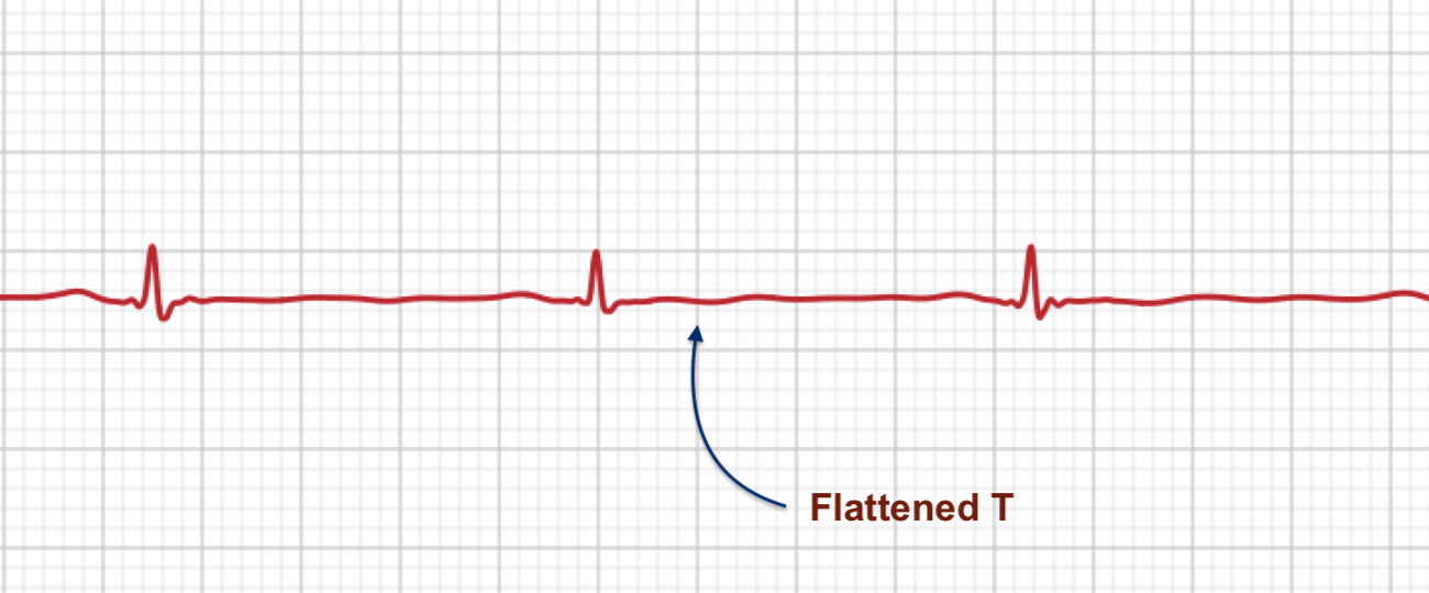 ECG+ app showing a flattened T wave on an Apple Watch ECG recording