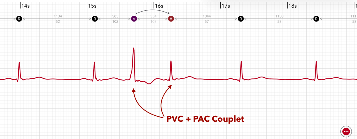 ECG+ App zeigt SVES- und VES-Couplets, zwei Extrasystolen in Folge in einem Apple Watch EKG