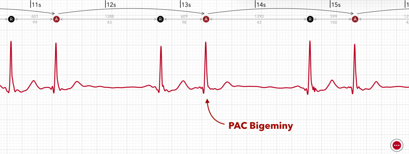 An Apple Watch ECG strip in ECG+ with each premature atrial beat marked by an A icon and an on-strip label reading PAC Bigeminy, showing every other beat arriving early