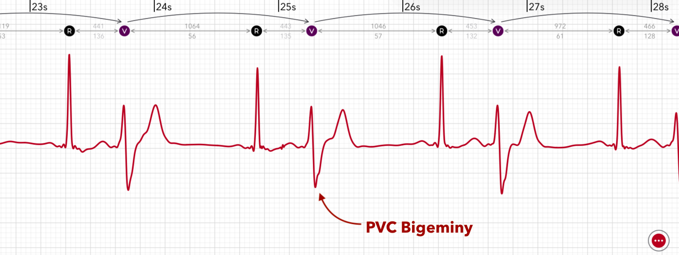 ECG+ 应用显示 Apple Watch ECG 上的 PVC 二联律，每隔一次心跳就是一次室性期前收缩