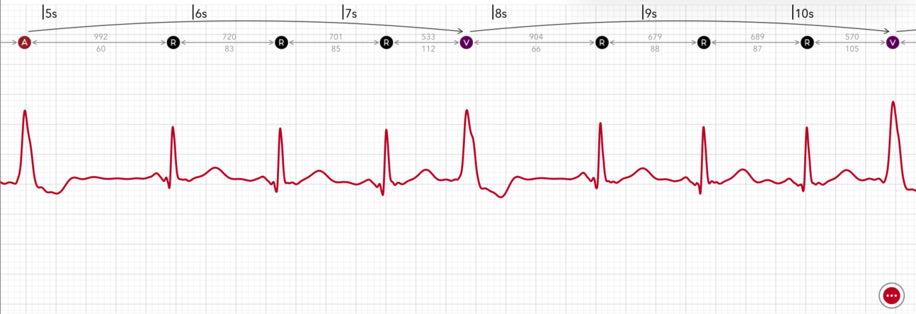 ECG+ App zeigt einen VES-Quadrigeminus, bei dem jeder vierte Schlag eine ventrikuläre Extrasystole in einem Apple Watch EKG ist