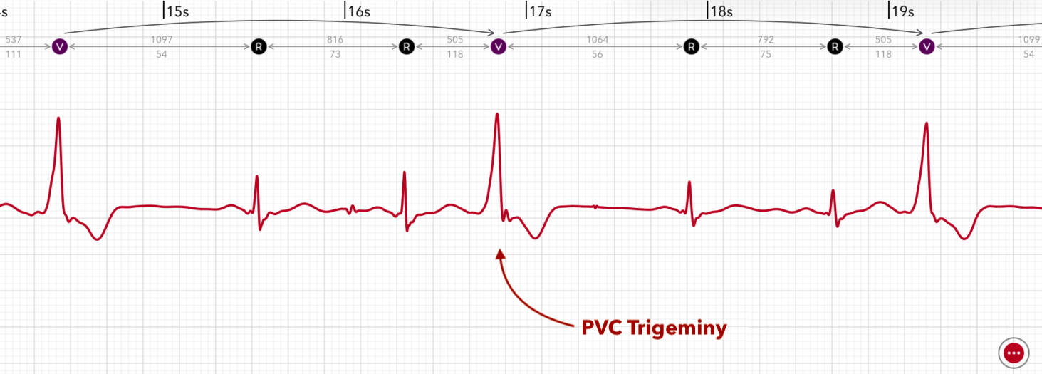 Apple Watch ECGで3拍ごとに1拍が心室期外収縮であるPVC三段脈を表示するECG+アプリ