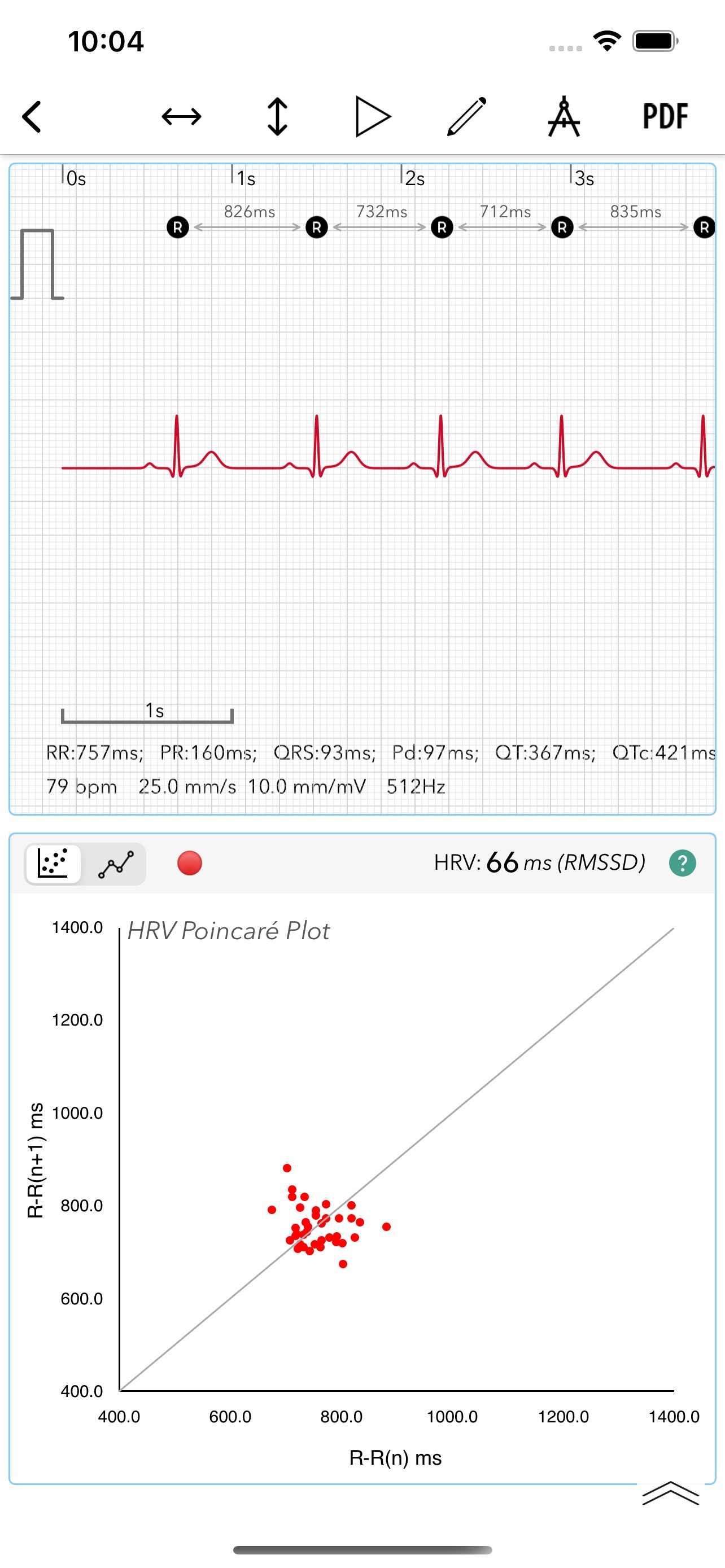 An early ECG+ screen from 2021 showing the annotated ECG strip with measurements and the HRV Poincaré plot