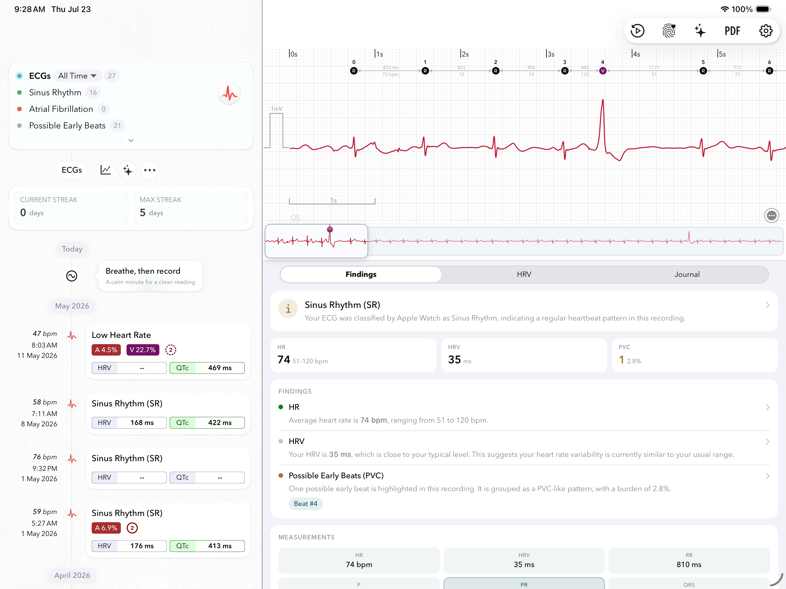 ECG+ im Vollbild auf einem iPad: links eine Zeitleiste früherer Aufzeichnungen, rechts ein einzelnes Apple Watch EKG mit annotierten Herzschlägen (R/A/V-Markierungen, RR-Intervalle), dem Schlag-Navigator und einem Befund-Panel mit Sinusrhythmus, Herzfrequenz, HRV und einer VES
