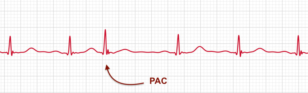 ECG strip showing a premature atrial contraction or PAC on an Apple Watch ECG report