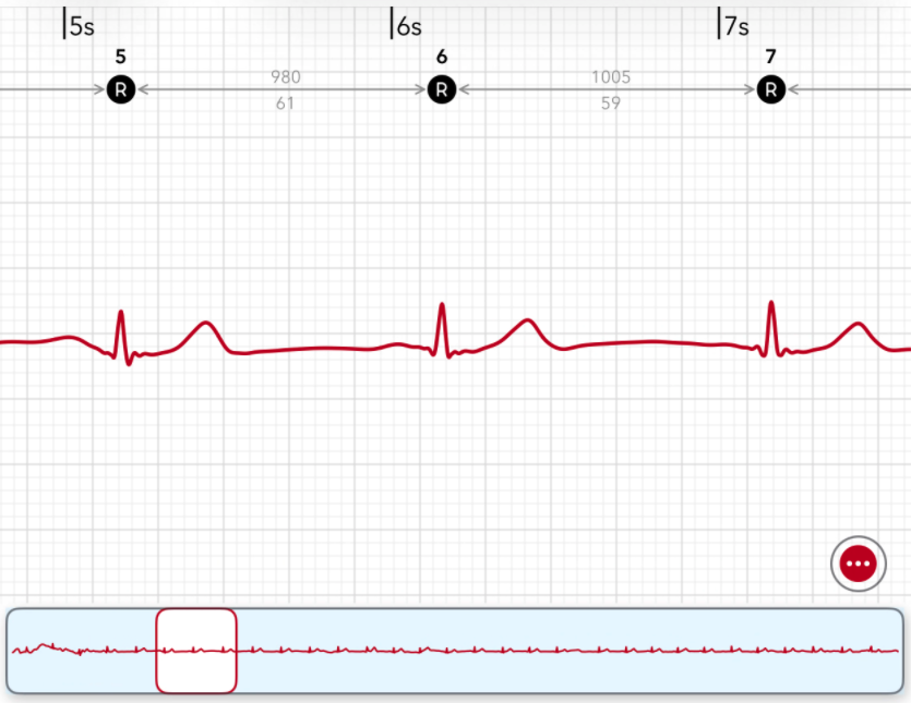 An Apple Watch ECG in ECG+ with annotated beats above and the Heartbeat navigator minimap along the bottom, the whole recording in miniature with a highlighted window showing the currently viewed section