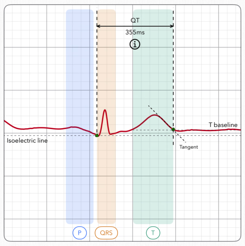 Eine Heartbeat Signature mit hervorgehobenen Bereichen der P-Welle, des QRS-Komplexes und der T-Welle sowie dem QT-Intervall und der Grundlinie