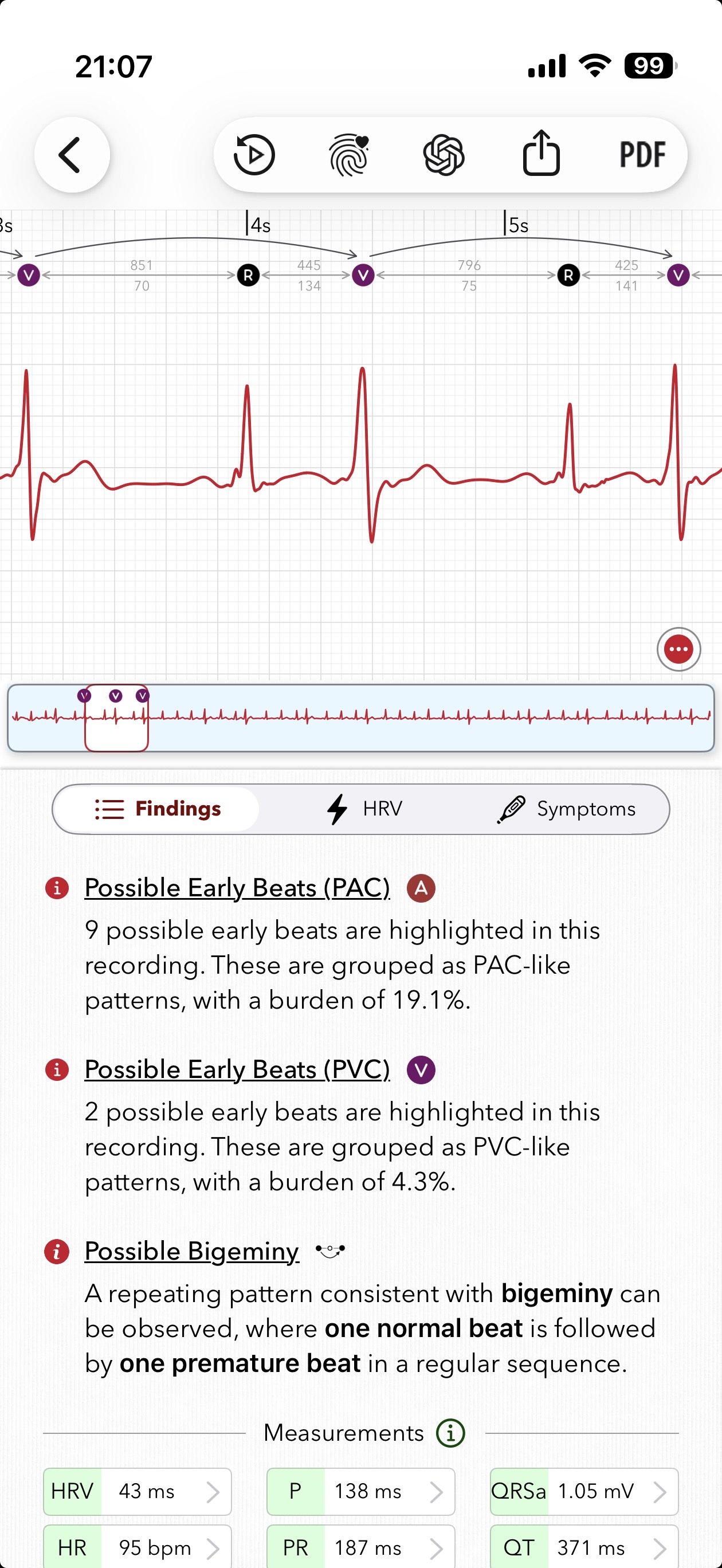 ECG+ app screenshot showing a PVC bigeminy pattern marked on an Apple Watch ECG report