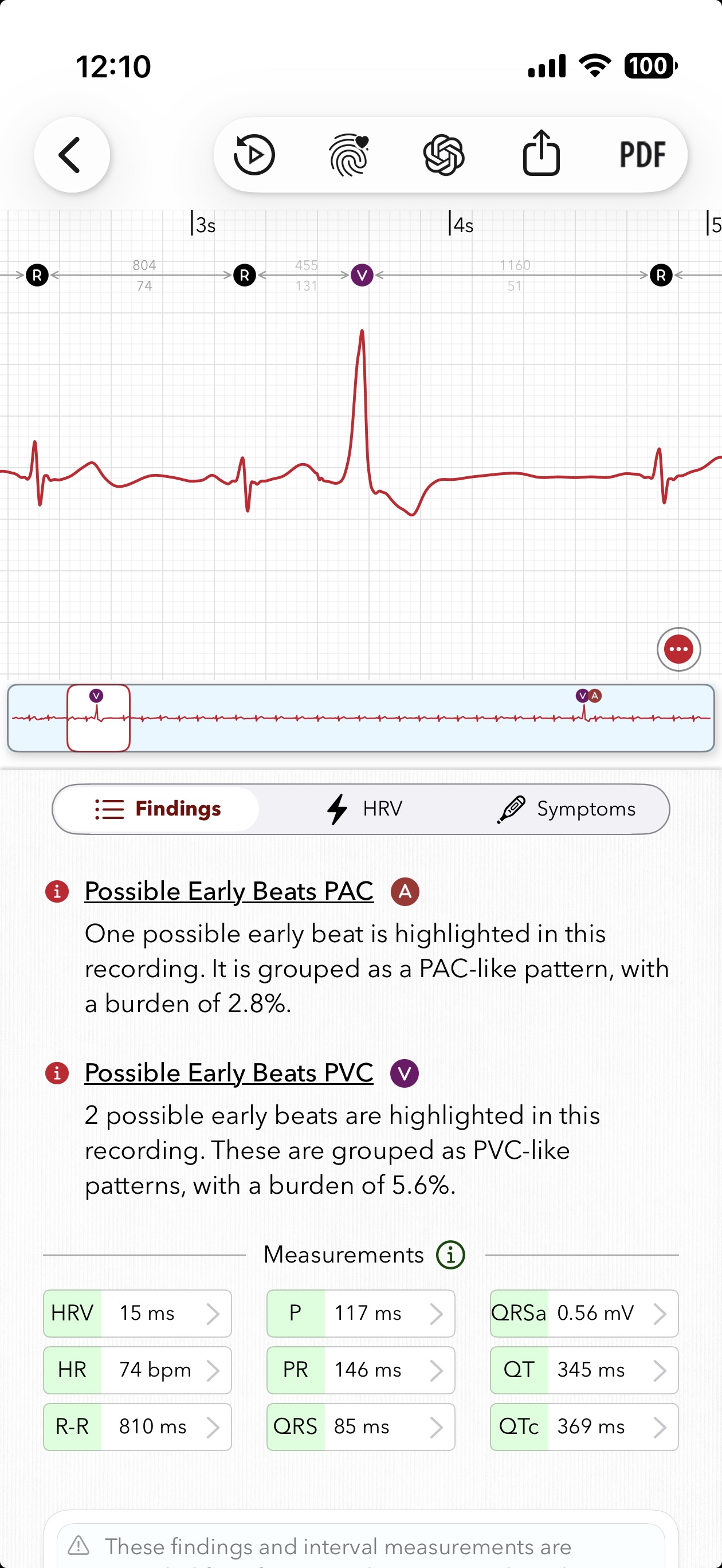 ECG+ app screenshot showing a PVC beat marked on an Apple Watch ECG report