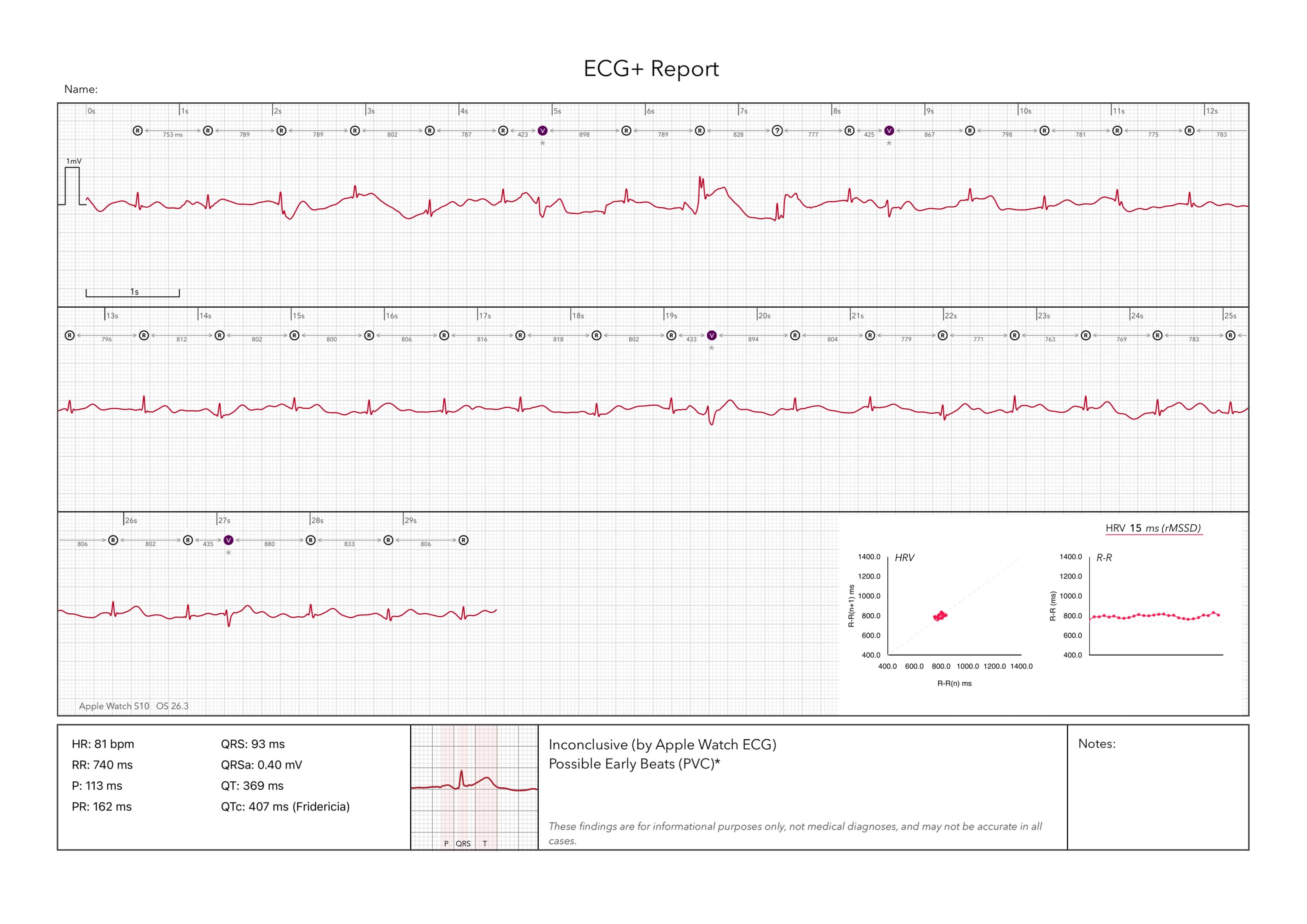 An inconclusive result on an Apple Watch ECG recording