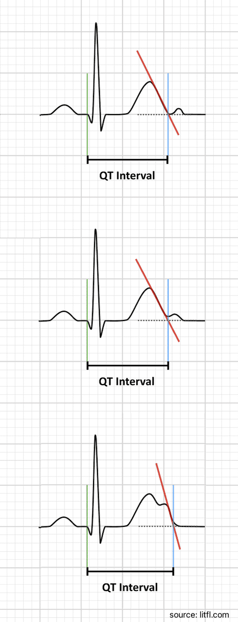 Measuring the QT interval when a U wave is present, using the maximum T-wave slope intersection method