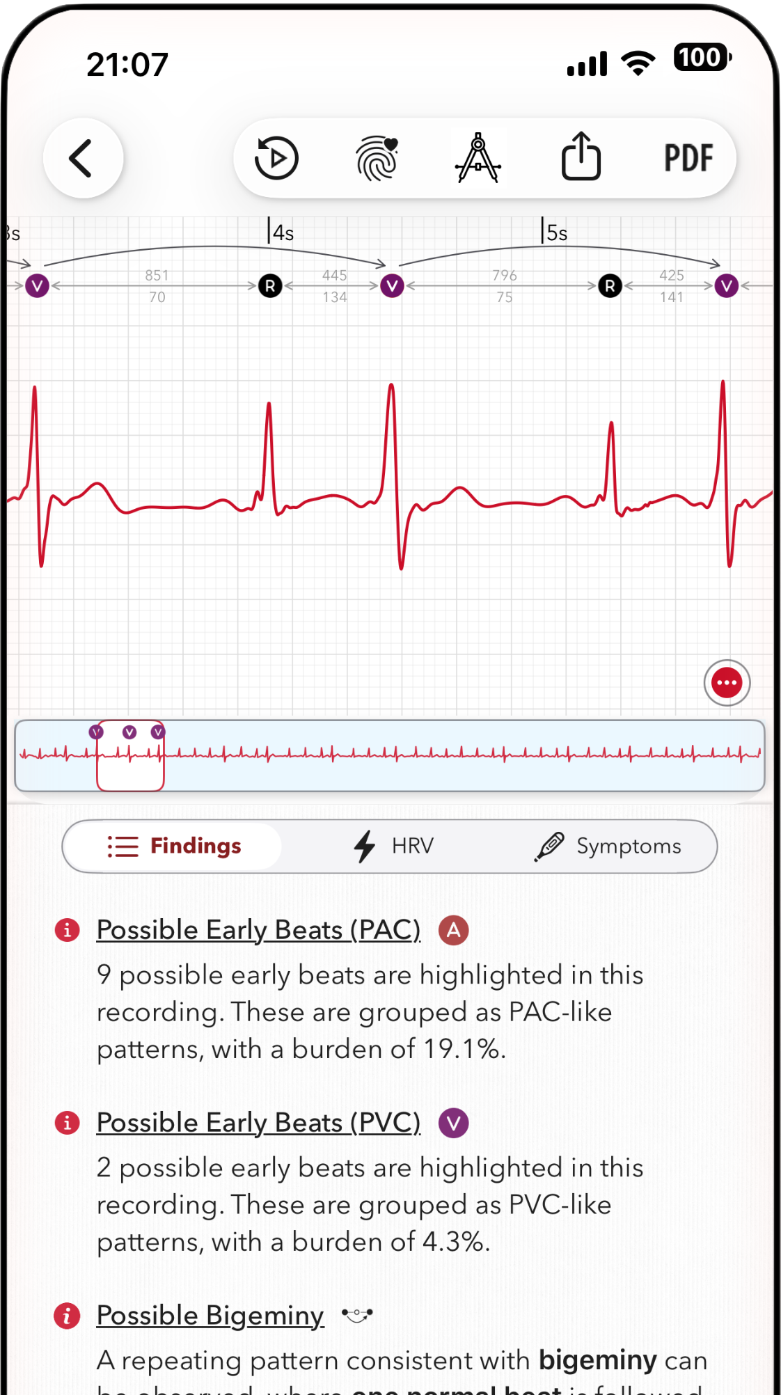 ECG+ app screenshot showing a PVC bigeminy pattern is marked on an Apple Watch ECG report
